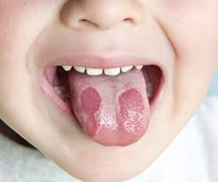 Một số trường hợp có thể có đau họng, ngạt mũi, chảy nước mũi, đau đầu, ho có đờm, nôn và tiêu chảy. Bá»‹ Loet á»Ÿ LÆ°á»¡i Khong Tháº¥y Ä'au Co Pháº£i La Biá»ƒu Hiá»‡n Cá»§a Bá»‡nh Ung ThÆ° Vinmec