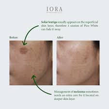 Image result for Solar Lentigo