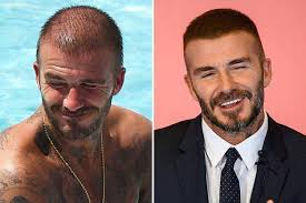 Il trapianto di capelli di david beckham, noto per i suoi lunghi capelli . Trattamento Per Capelli David Beckham
