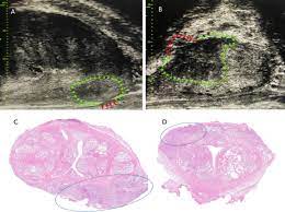 prostate cancer is the most common cancer among men. Use Of 29 Mhz Micro Ultrasound For Local Staging Of Prostate Cancer In Patients Scheduled For Radical Prostatectomy A Feasibility Study European Urology Open Science