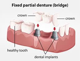 We did not find results for: How Is A Dental Bridge Attached
