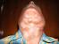 Swollen Neck Lymph Nodes