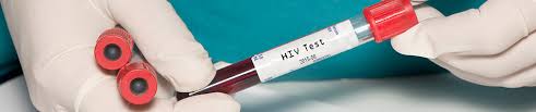 Ist der bestätigungstest ebenfalls positiv, so wird der arzt die diagnose „hiv positiv stellen. Hiv Testen Ratiopharm Gmbh