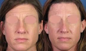 Fake a nose job with contouring how to reduce/prevent nasolabial fold (smile lines, laugh lines)  . Bulbous Rounded Nasal Tip