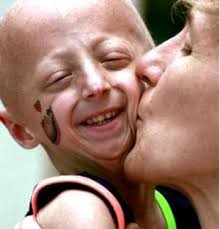 Image result for progeria case in bihar