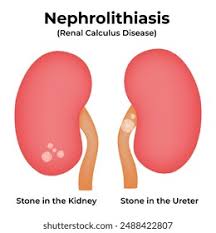 Image result for Nephrolithiasis