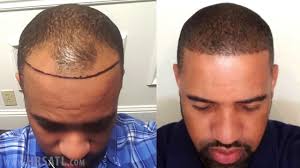 Norwood 3, this black men hair growth patient was a 3 on the norwood scale. African American Hair Transplant Before And After One Year Youtube