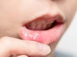 It often takes a few months for tongue cancer to develop the first noticeable symptoms. Signs Of Oral Cancer What Not To Ignore General And Cosmetic Dentistry The Parkway Dentist