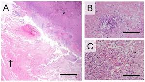 Mucormycosis is one of the fungal infections out of the series of infections discussed at sqadia.com. Pathophysiological Implication Of Reversed Ct Halo Sign In Invasive Pulmonary Mucormycosis A Rare Case Report Diagnostic Pathology Full Text