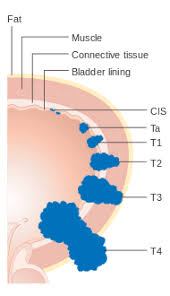 Image result for Bladder Cancer Staging