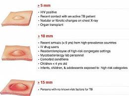 While other investigations may strongly suggest tuberculosis as the diagnosis, they cannot confirm it. Tuberculin Skin Test Positive Mantoux Test Result Grepmed