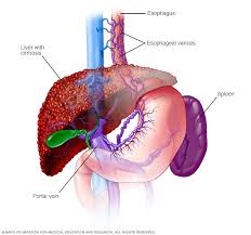 Stream tracks and playlists from spleen on your desktop or mobile device. Ù…Ø±Ø¶ Ø§Ù„ÙƒØ¨Ø¯ Ø§Ù„Ø¯Ù‡Ù†ÙŠ ØºÙŠØ± Ø§Ù„ÙƒØ­ÙˆÙ„ÙŠ Ø§Ù„Ø£Ø¹Ø±Ø§Ø¶ ÙˆØ§Ù„Ø£Ø³Ø¨Ø§Ø¨ Mayo Clinic Ù…Ø§ÙŠÙˆ ÙƒÙ„ÙŠÙ†Ùƒ