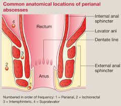 Image result for Ischiorectal Abscess