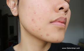 Baking soda ini menyerap masuk ke dalam pora kulit dan membersihkannya dan juga mengelakkan jerawat baru naik. Bio Oil Untuk Bekas Jerawat First Impression Lia Harahap