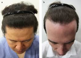 However, there are increasing cases of hair loss in asians due to implementation of western style. 27 Hair Transplantation In East Asians Plastic Surgery Key