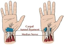 Check spelling or type a new query. Carpal Tunnel Syndrome Symptoms Causes Surgery Southern Cross Nz