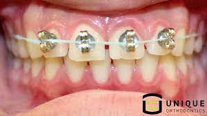 Content updated daily for at home braces for teeth Diy Braces Are A Thing But Not A Good One Abc13 Houston