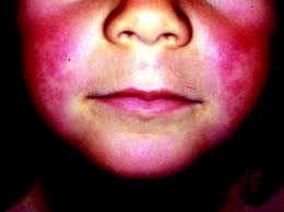 The discolored spots of senile purpura have also been called blood spots or skin hemorrhages. 8 Management Of Allergy Rashes And Itching Emergency Medicine Journal