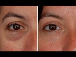 How To Make Eye Bags Vanish Cure Puffy Eyes Under Eye Wrinkles Under Eye Bags