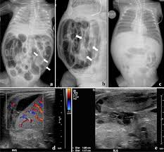 Image result for Necrotizing Enterocolitis