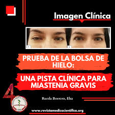 Request pdf | on jan 1, 2014, lorena godoy and others published miastenia ocular y ophthalmologists may be more involved in the future in diagnosing the ocular lesions of measles. Prueba De La Bolsa De Hielo Una Pista Clinica Para Miastenia Gravis Revista Medico Cientifica