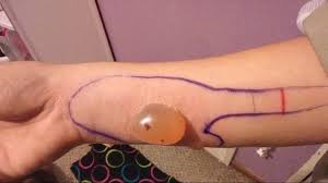 But can a brown recluse bite really lead to the loss of a limb? Woman Hospitalized After Being Bitten By A Brown Recluse Spider 11alive Com