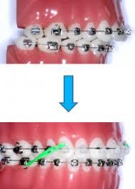Rubber bands on braces help to fix bite issues things like an overbite, underbite or even crossbite. Suter Orthodontics Orthodontist Colorado Springs Co Dr Scott Suter Dental Braces Braces Rubber Bands Fix Overbite