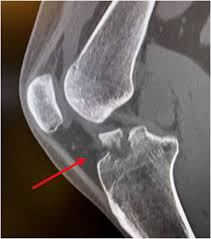 Arthroscopic Assisted Anterior Cruciate Ligament Tibial Spine Avulsion  Reduction and Cortical Button Fixation - Arthroscopy Techniques