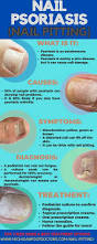 Image result for Pitting nails feet
