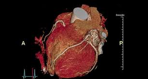 I sintomi dell'infarto nelle donne sono un tema molto dibattuto e discusso, soprattutto in questi ultimi decenni, in cui si è assistito a un aumento dell'incidenza dell'attacco di cuore nella popolazione femminile. Covid 19 Il Virus Puo Provocare Infarto Senza Lesioni Delle Coronarie La Repubblica