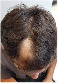 Yes, you read that correctly, hair loss is a health problem. Alopecia Areata After Omalizumab Treatment For Chronic Spontaneous Urticaria Html Acta Dermato Venereologica