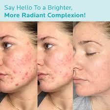 Image result for Azelaic Acid