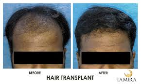 Hair Transplant In Chennai No 1 Hair Loss Treatment