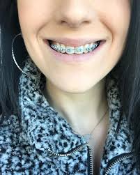 Getting braces can mean some major adjustments. How To Get Braces For Free Arxiusarquitectura