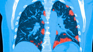 Maybe you would like to learn more about one of these? Some Patients Who Survive Covid 19 May Suffer Lasting Lung Damage Science News