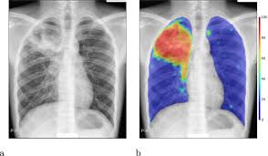 This manual would not have been possible without the comments and suggestions of colleagues with considerable. Computer Aided Detection Of Tuberculosis On Chest Radiographs An Evaluation Of The Cad4tb V6 System Scientific Reports