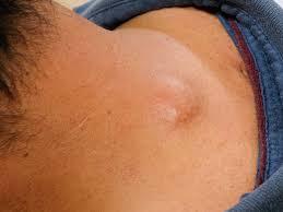 The boils will go away by themselves after a time, much like pimples. Ingrown Hair Cyst Treatments Causes And Prevention