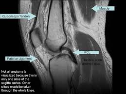 Knee joint anatomy is complex with muscles, ligaments, cartilage and tendons. Mri Anatomy Knee