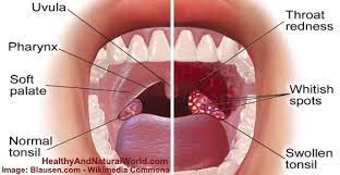 Doctors Reveal 6 Common Causes Of White Spots On Throat Images Included White Spots On Throat Throat Throat Infection