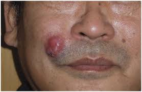 Image result for Dermatofibrosarcoma Protuberans