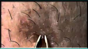 Ingrown hairs can crop up anywhere, from the legs to the bikini line and under arms to the jawline, so how according to the nhs an ingrown hair can occur when the hair follicle becomes clogged with. Most Satisfying Ingrown Hair Removal Youtube