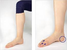 Das sind schmerzen unter der ferse. Knick Senkfuss Schwache Der Tibialis Posterior Sehne Gelenk Klinik De