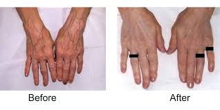 So you want to know how to make veins pop out? Hand Veins Treatment And Removal Madison Vein Laser