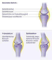 Arthrose Gelenkerhaltende Therapie Gelenk Klinik De