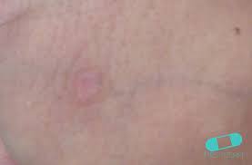 Image result for syphilis ulcer