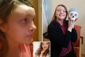 Student who lost half her skull after tumour was misdiagnosed as an allergy  to her pet rabbit now has a 3D-Printed replacement