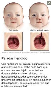 Labio y paladar hendido con el dr. Historias De Labio Paladar Hendido Home Facebook