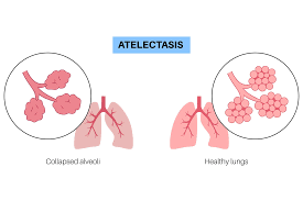 Image result for Atelectasis