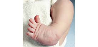 Symptoms of clubfoot in babies. Clubfoot Curved Baby Feet Next Step Foot Ankle Clinic