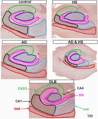How many mm in 1 pt? Disease Related Microglia Heterogeneity In The Hippocampus Of Alzheimer S Disease Dementia With Lewy Bodies And Hippocampal Sclerosis Of Aging Acta Neuropathologica Communications Full Text